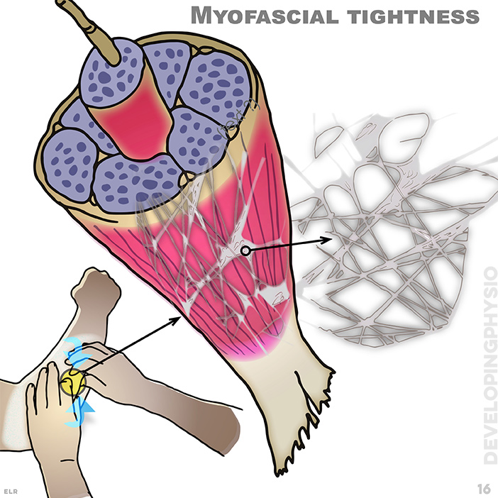 Myofascial tightness: a network of fascia surrounds all tissue