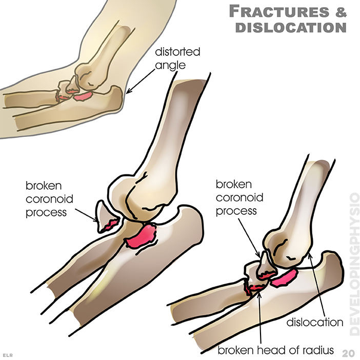 Fractures & dislocation