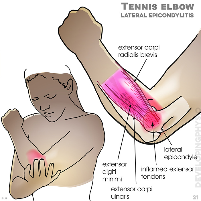 Tennis elbow: lateral Epicondylitis