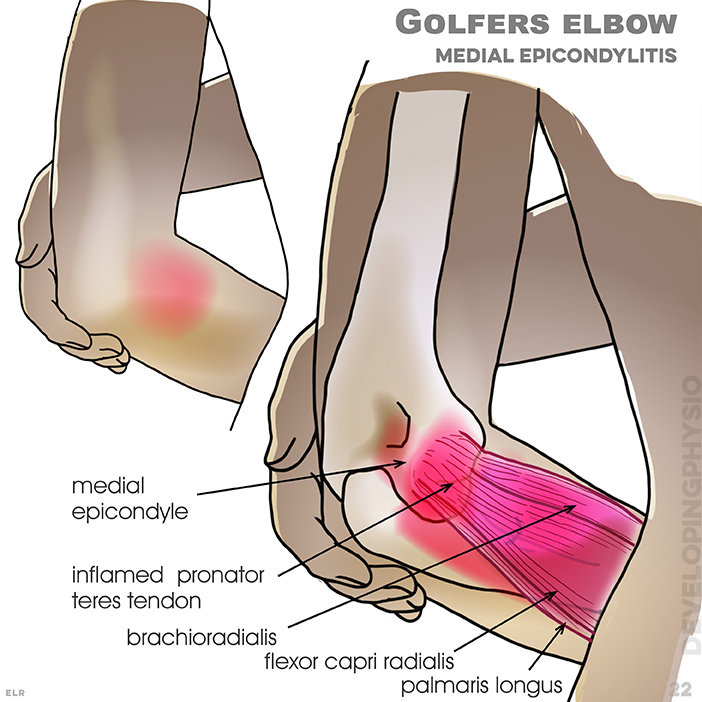 Golfers elbow: medial Epicondylitis