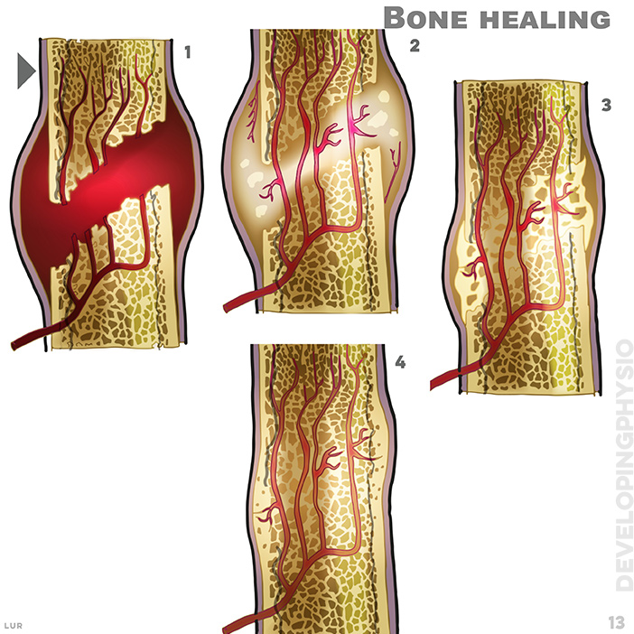 Bone healing: haematoma, week 1. soft callus, week 2 to 3. hard callus weeks 4 to 16. remodelling week 17 onwards